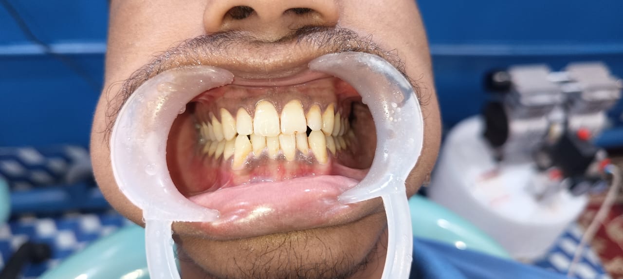 After Tooth Extraction