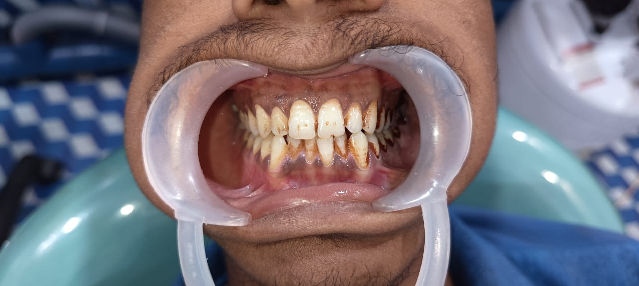 Before Tooth Extraction