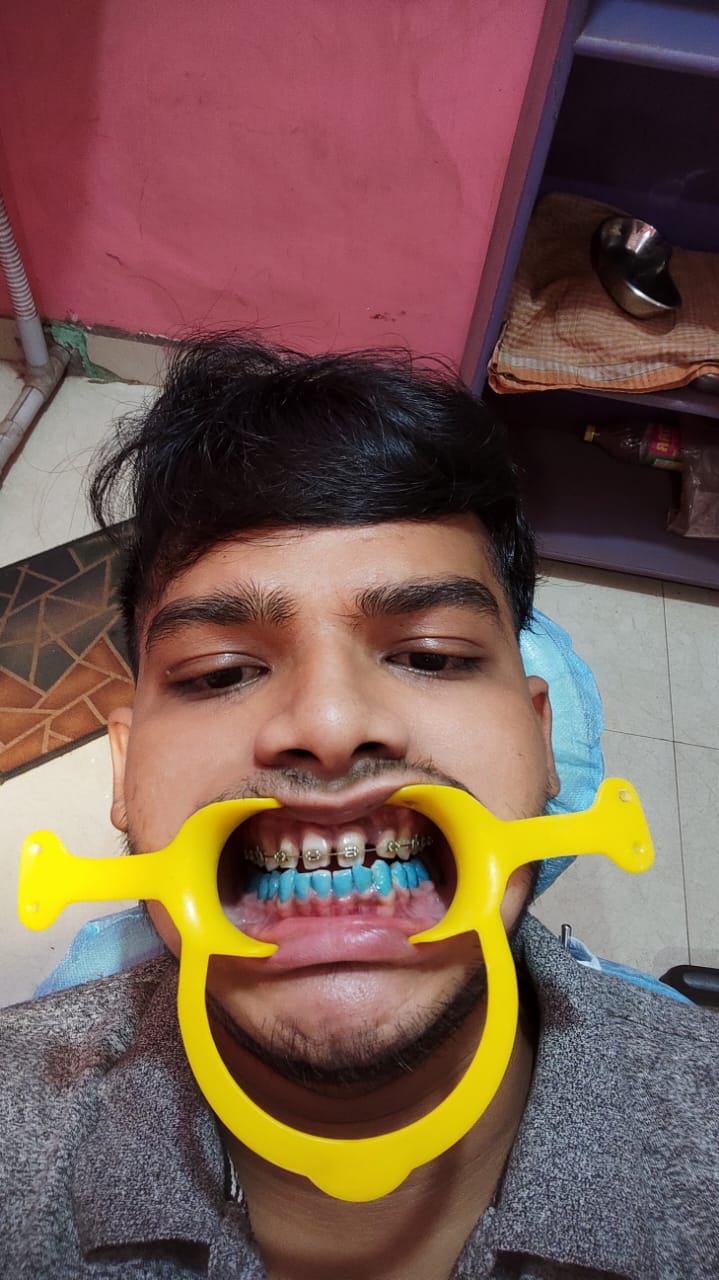 Before Tooth Extraction