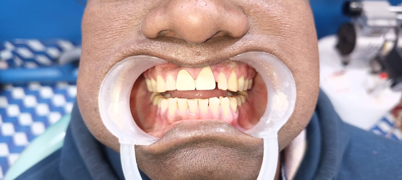 After Tooth Extraction