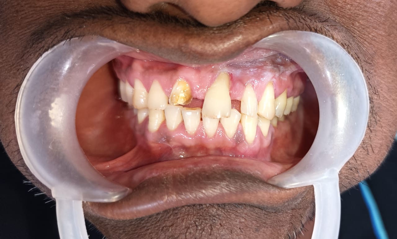 Before Tooth Extraction