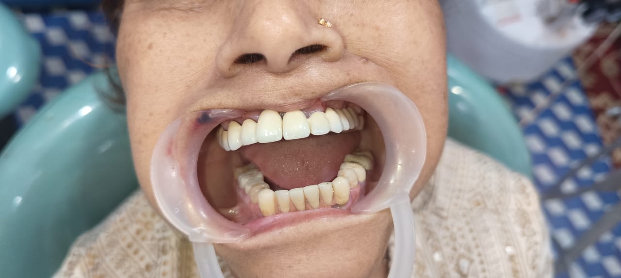 After Tooth Extraction